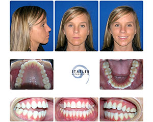 Orthodontic treatment results showing before/after dental photos and patient smile transformation.
