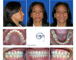 Patient before and after orthodontic treatment showing facial profile and dental alignment improvements.