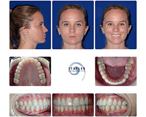 Orthodontic patient before and after treatment showing facial profile and dental alignment changes.