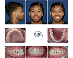 Patient mugshots and intraoral dental photographs showing before orthodontic treatment results.