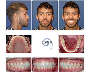 Male patient mugshots and before/after orthodontic treatment showing dental alignment improvements.