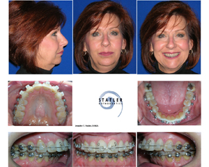 Before and after orthodontic treatment showing facial profile, dental occlusion, and smile transformation with braces.