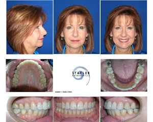 Orthodontic before-and-after treatment showing facial profile views and dental results with braces and final smile.