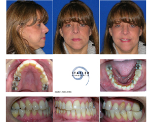 Before and after orthodontic treatment: patient profile views and dental X-rays showing teeth alignment correction.