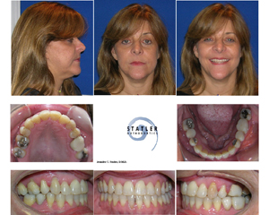 Patient before and after orthodontic treatment showing facial profile and dental alignment improvements.