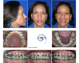Female orthodontic patient showing before and after facial profile and dental treatment with braces.