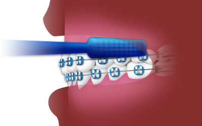 Blue braces with numbered teeth indicators on red dental model background.