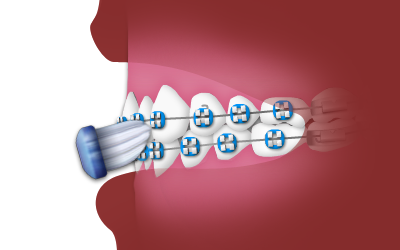 Dental braces with blue brackets attached to tooth model against red gradient background.