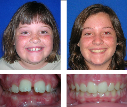 Before and after orthodontic treatment showing patient's smile and dental alignment improvement.