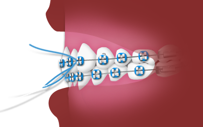 Dental braces with blue wire attached to teeth against red background.