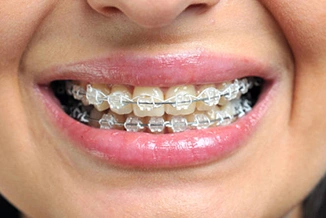 Close-up of smile displaying metal braces on upper and lower teeth with pink lips.