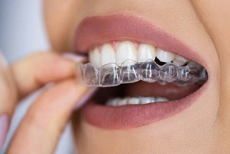 Person inserting clear orthodontic aligner into mouth, showing teeth alignment treatment.