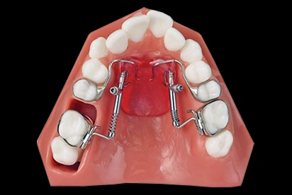 Orthodontic model showing palatal expander device attached to upper teeth for dental treatment.