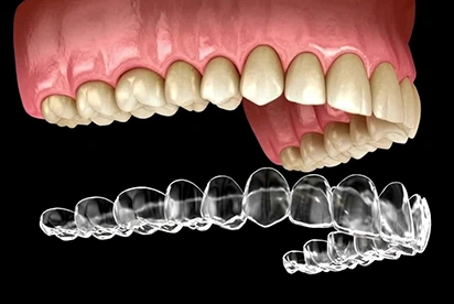 Clear aligners positioned below digital model of teeth with pink gums for orthodontic treatment visualization.