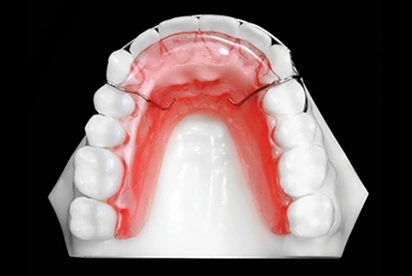 3D dental model showing upper arch with red highlight indicating orthodontic treatment area.
