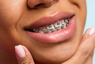 Close-up of person smiling showing metal braces on upper teeth