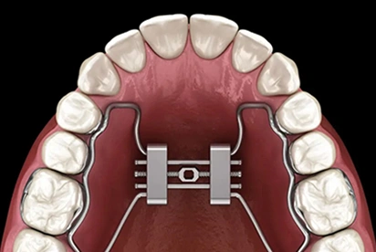 Palatal expander device installed in upper dental arch to widen jaw during orthodontic treatment.