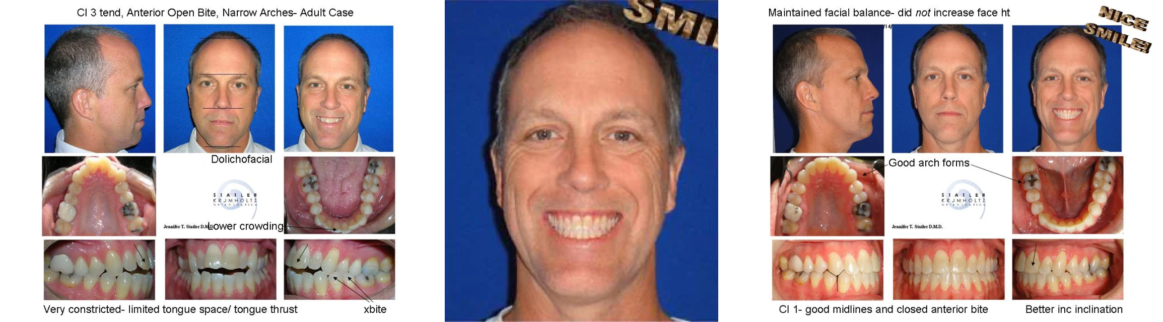 Before and after orthodontic treatment results showing patient's smile transformation from multiple angles.