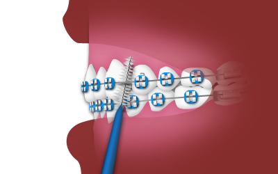 Orthodontic braces with blue wire on pink tooth model showing dental alignment treatment.
