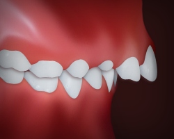 Misaligned teeth displayed against red background showing orthodontic treatment need.