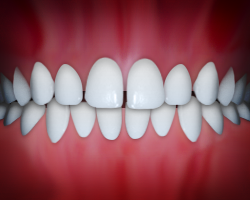 Perfect white teeth aligned in ideal bite, dental model or illustration showing orthodontic results.