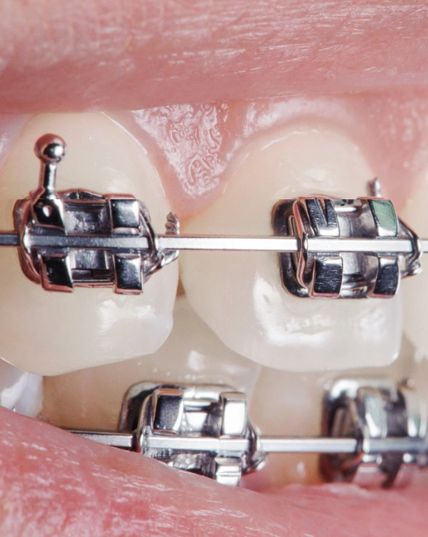 Four metal orthodontic braces displayed on pink and white mounting bases against pink background.