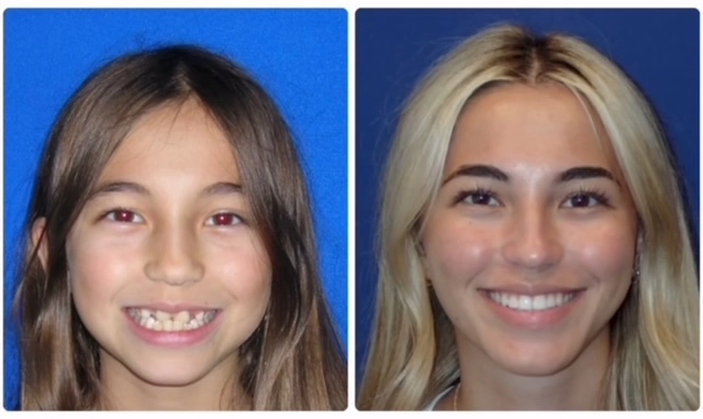 Two smiling women in portrait photos against blue backgrounds, before and after orthodontic treatment.
