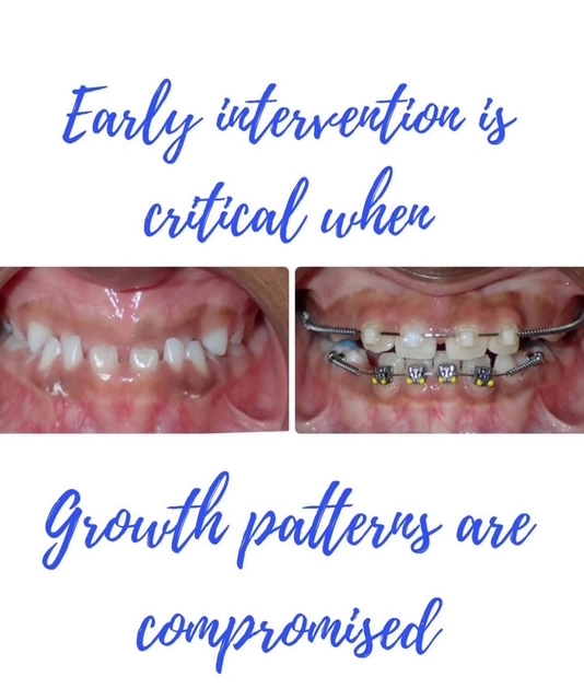 Two dental photos showing compromised growth patterns, with text emphasizing early intervention importance in orthodontics.