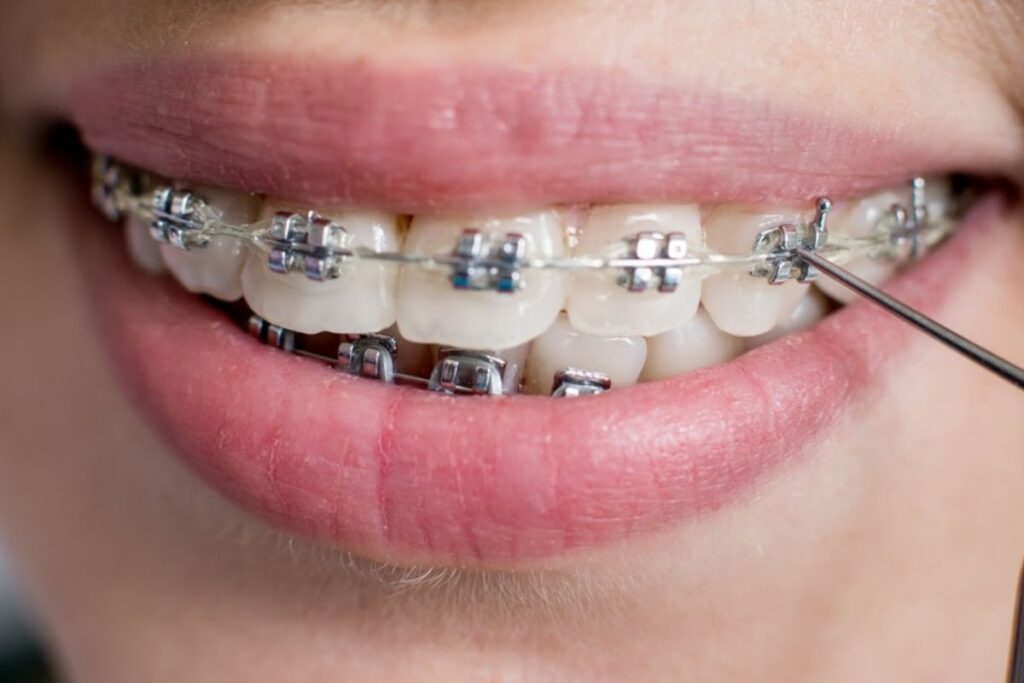 Can I Play Sports Safely While Wearing Dental Braces